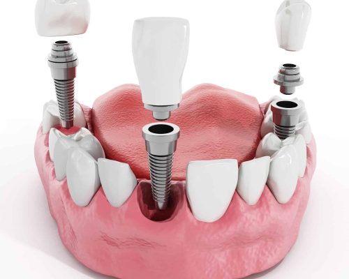 Implanty zębowe Mikołów